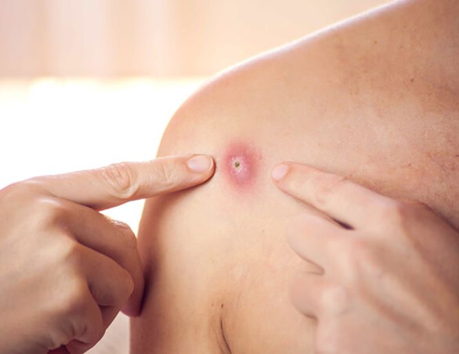 Abscess & Cyst Removal