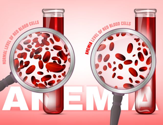 Anemia Treatment