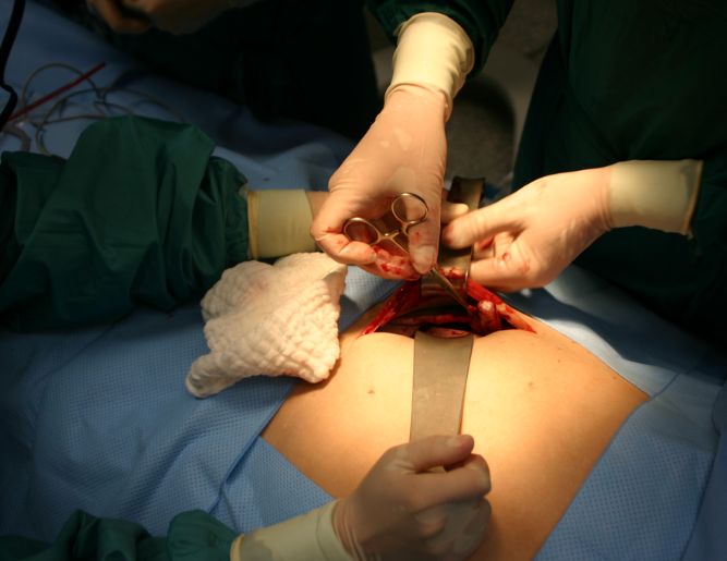 Appendix Surgery (Appendectomy)