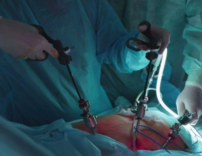 Bladder Stone Surgery