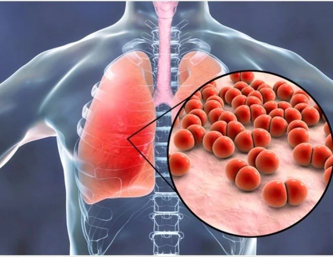 Chest Infection & Pneumonia Treatment