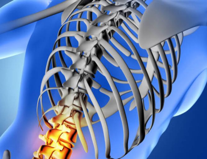 Discectomy
