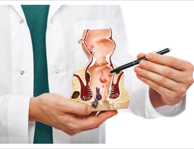 Fissure & Fistula Treatment