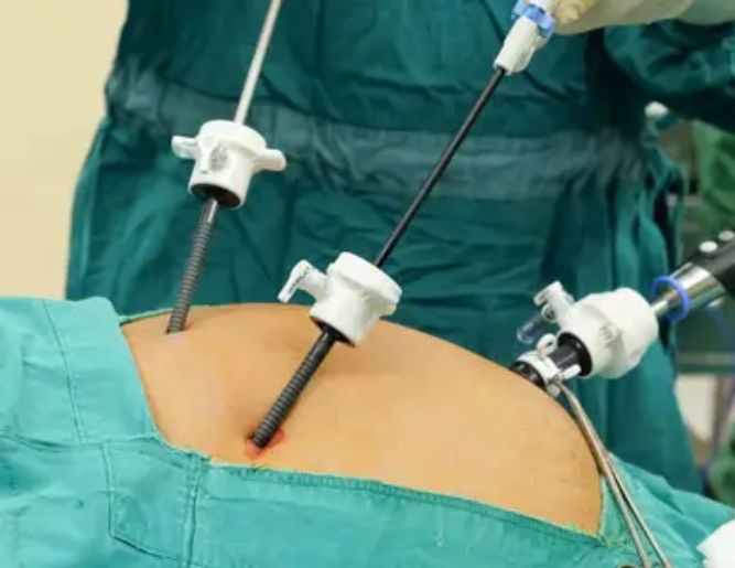 Gall Bladder Stone Surgery