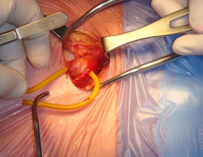 Hernia Surgery