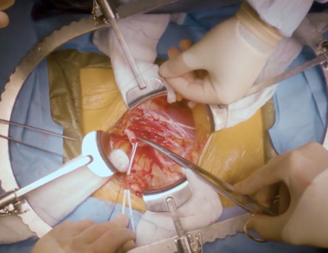 Kidney Surgery