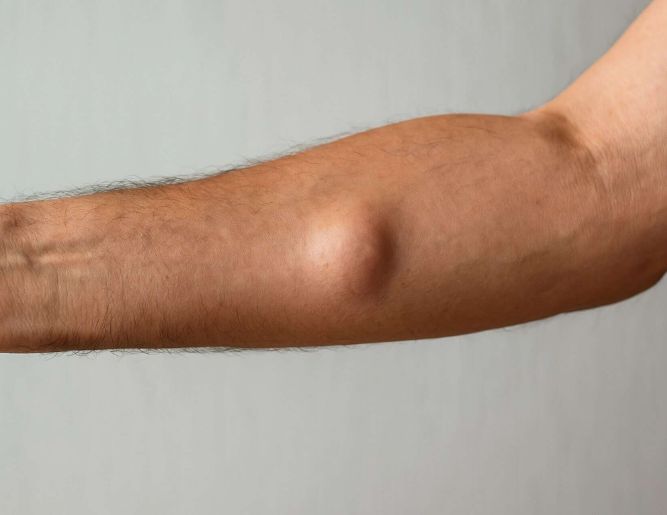 Lumps & Swelling Removal