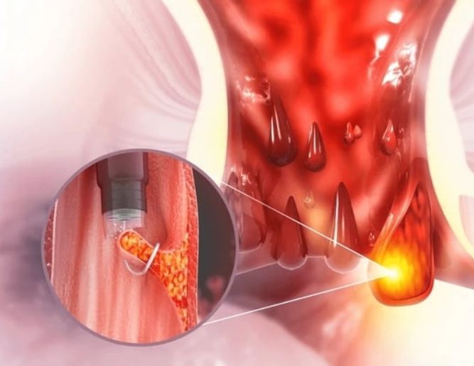 Piles (Hemorrhoids) Treatment