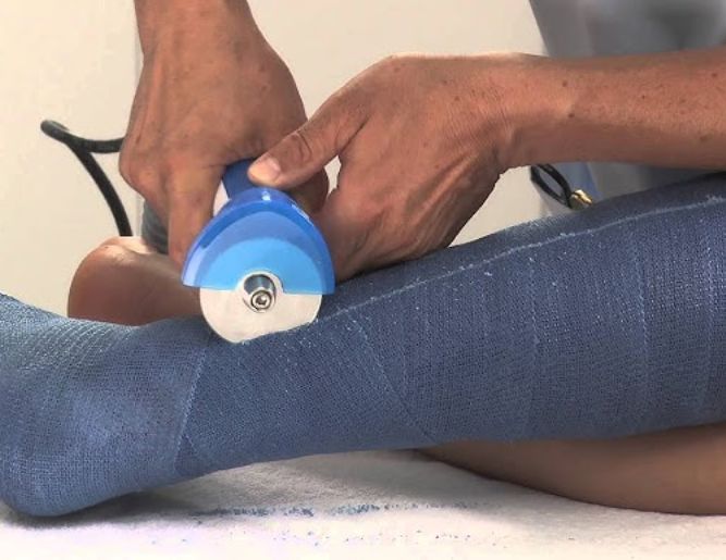 Plaster / Cast Application & Removal