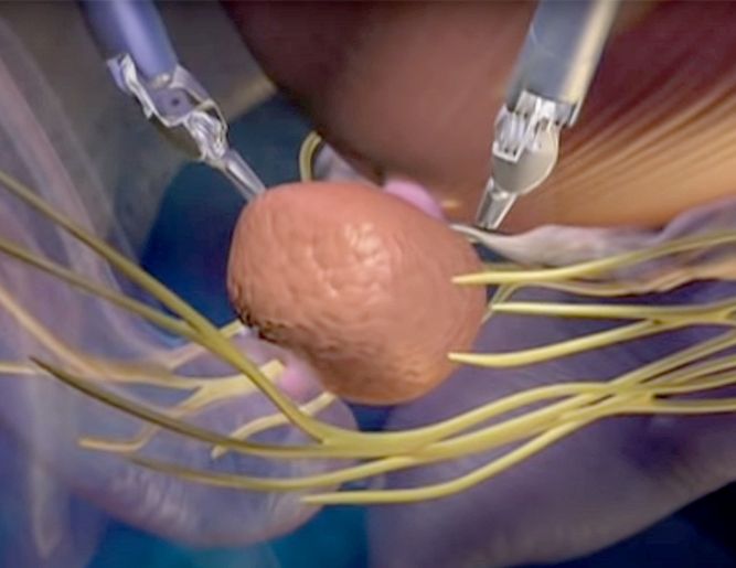 Prostate Surgery