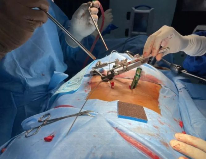 Spine Surgery