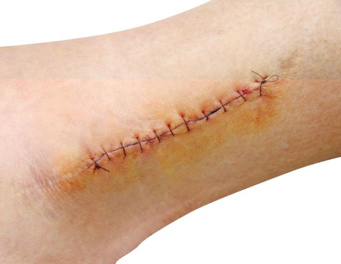 Suturing of Cuts & Injuries