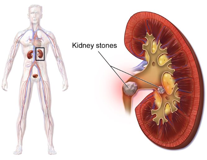 Ureteric Stone Treatment