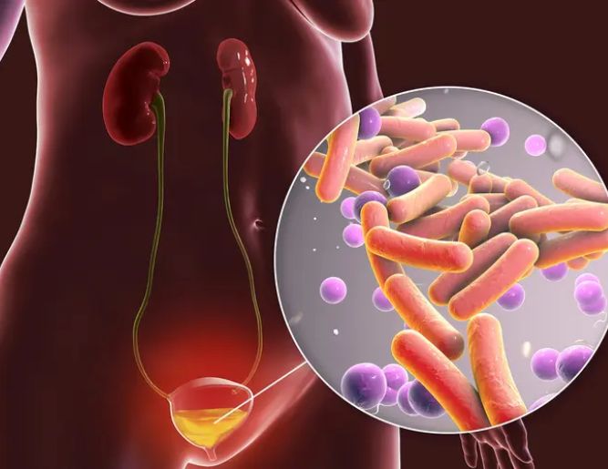 Urinary Tract Infection (UTI) Treatment